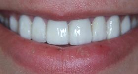 Three broken front teeth after repair