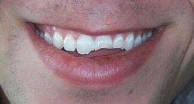 Closeup of smile with three broken front teeth