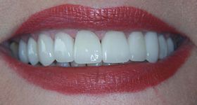 Brilliant white healthy smile closeup