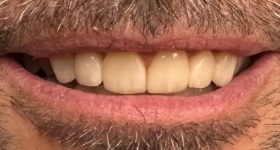 Closeup of closed gap between front teeth