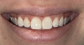 Closeup of gap between front teeth