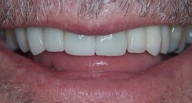 Closeup of closed gap between front teeth