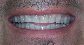 Severely decayed  and discolored teeth