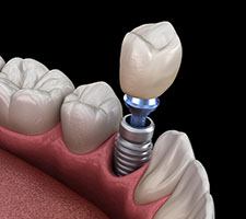 Digital model of dental implant being inserted into jaw