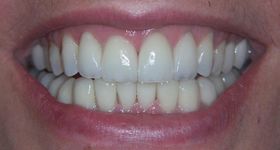 Closeup of smile with teeth that touch