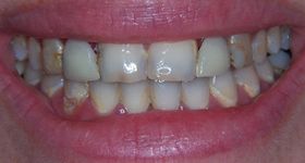 Closeup of smile with severe tooth decay and damage