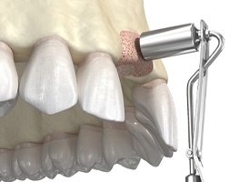 illustration of a dental bone graft in Pittsburgh