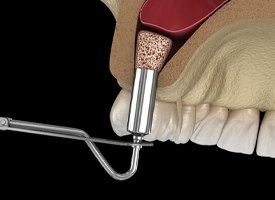 illustration of a sinus lift in Pittsburgh