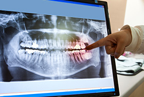 Digital x-rays on computer