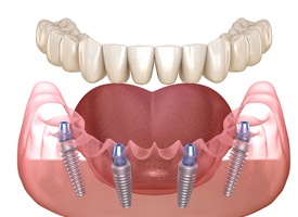 Full arch to be supported by All-on-4 implants