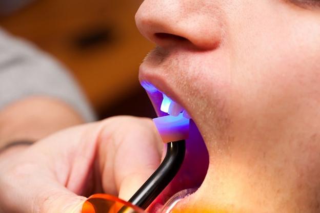 man getting direct bonding hardened with curing light