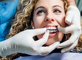 Gloved hands placing clear aligner over woman’s upper arch