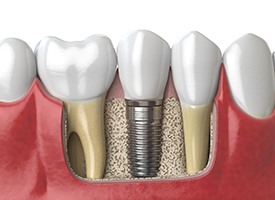 Model of dental implants in Pittsburgh
