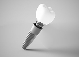 Closeup of model of dental implant in Pittsburgh