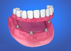 full denture attached to four dental implants 