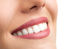 Woman’s smile with well-proportioned gums after gum recontouring