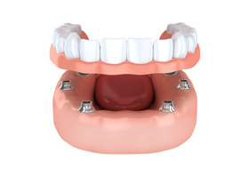 Model of smile with implant retained crown