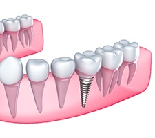 Image of single dental implant in Pittsburgh, PA
