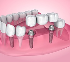 Model of bridge supported by dental implants in Pittsburgh, PA