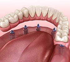 Illustration of dentures supported by dental implants in Pittsburgh, PA
