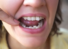 Closeup of crooked teeth