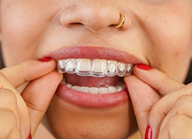 Woman putting in clear aligners