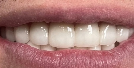 smile after dental implant