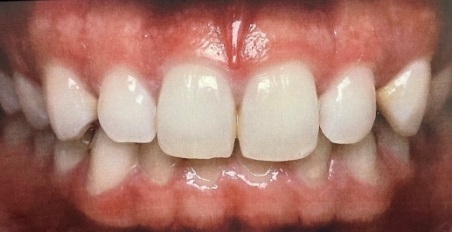 smile before dental implant