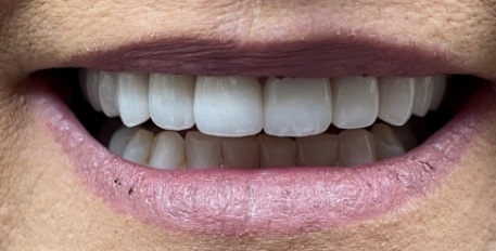 patient after gummy smile correction
