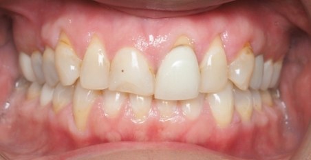 patient before gummy smile correction