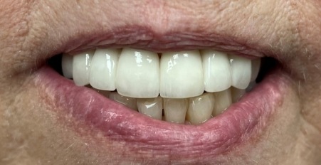 smile after porcelain veneers