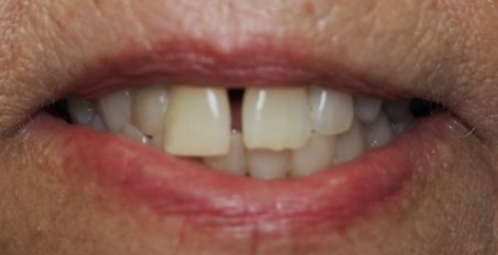 smile before porcelain veneers