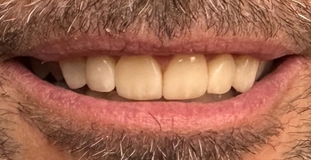 smile after porcelain veneers
