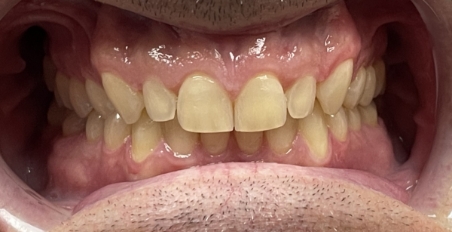 smile before porcelain veneers