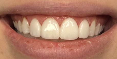 smile after porcelain veneers