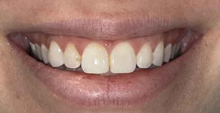 smile before porcelain veneers