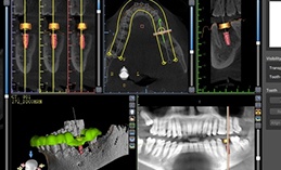 Digital X-Ray