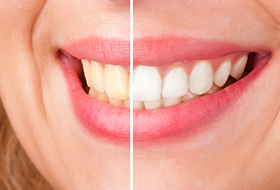 Closeup of smile half before and half after teeth whitening