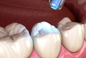 computer illustration of a dental filling being cured by an ultraviolet light