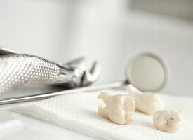 extracted teeth sitting on a piece of gauze next to a pair of forceps and a dental mirror