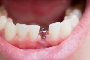 A closeup of a dental implant inside a person’s jaw.