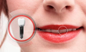 Dental implant next to woman's smile