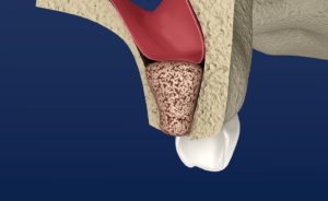 Image of a bone graft before a dental implant