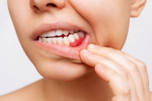 Woman pulling back her lip to reveal red gums